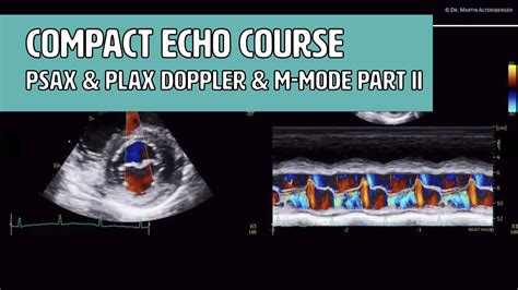 m-mode lv echocardiography plax|plax echocardiogram.